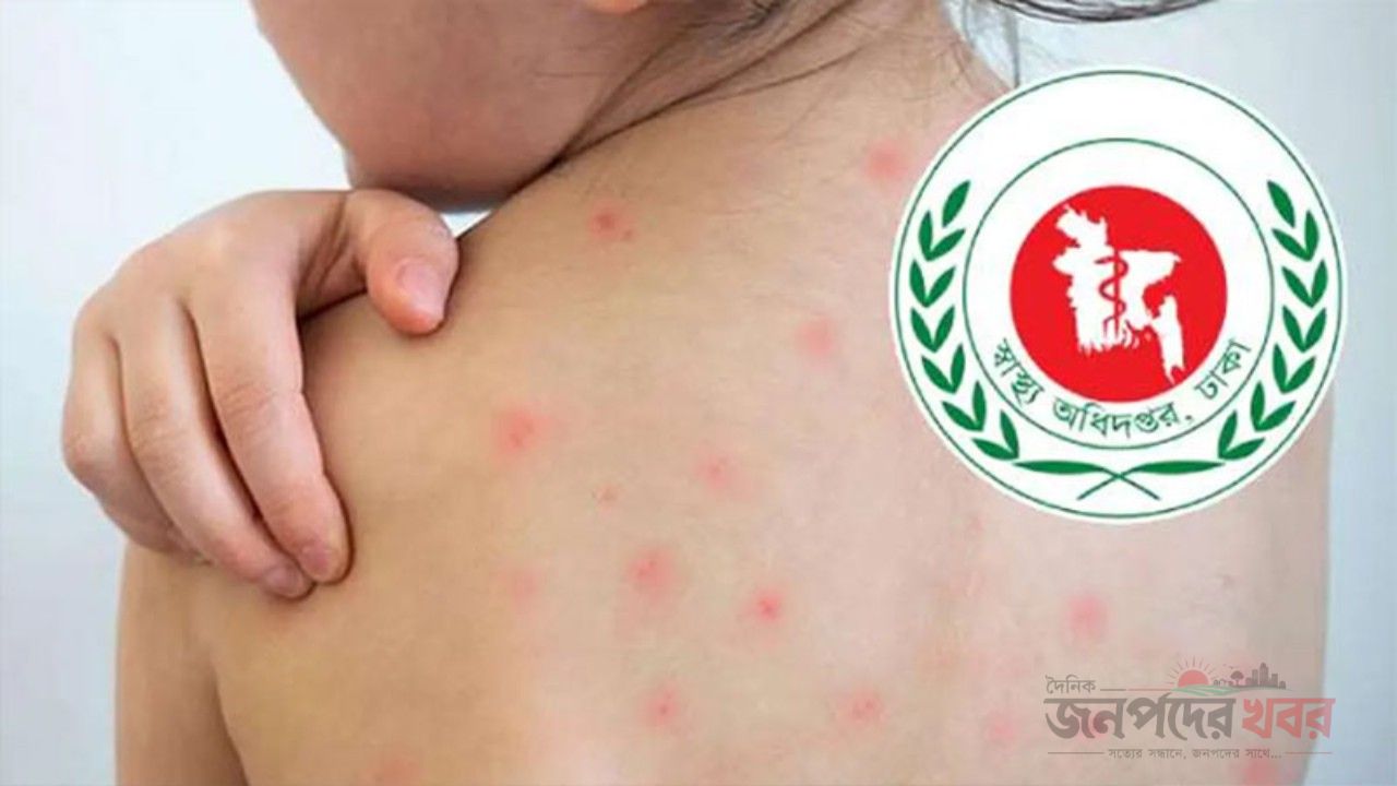 হামের উপসর্গে আরও ৯ জনের মৃত্যু