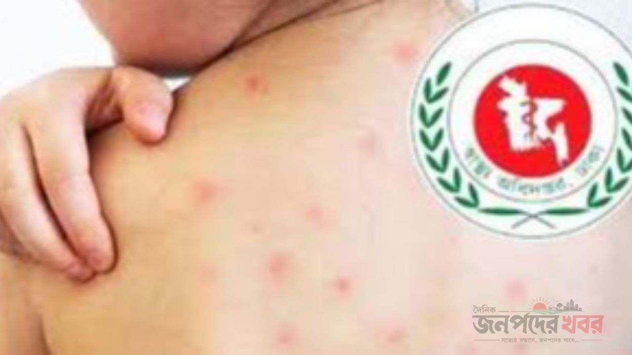 হামে আরও ২ শিশুর মৃত্যু, আক্রান্ত ১২১৪